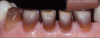 Fig 13. Tooth preparations showing dark discoloration
