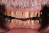 Fig 2. Severe wear was noted on maxillary and mandibular teeth.