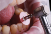 Fig 3. The leading labioincisal edge of the mandibular incisors was defined.