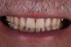 Fig 10. The maxillary incisal edges were in uniform convexity in relation to the lower lip curvature (Fig 10) and were angled toward the inner vermillion border of the lower lip (Fig 11).