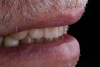 Fig 11. The maxillary incisal edges were in uniform convexity in relation to the lower lip curvature (Fig 10) and were angled toward the inner vermillion border of the lower lip (Fig 11).