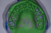 Fig 1. Full-arch putty wash diagnostic impression.