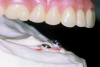 Fig 1. Advanced mandibular atrophy of the ridge can be optimally restored with a removable implant-supported prosthesis.