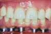 Fig 2. Historically, the construction of prostheses left the rehabilitation raised above the gingiva. These were referred to as a high-water hybrid.