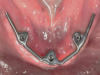 Fig 5. A mandibular bar can facilitate angulation corrections of malaligned implants, idealize parallelism of retentive elements, and provide better hygiene access than a fixed prosthesis because the overdenture can be removed.