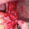 Fig 7. Intraoperative photograph showing a distinct layer of solidified grafted material covering the Schneiderian membrane after removal of failed bone graft.