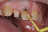 Fig 5. A universal bonding agent is applied, followed by dentin opacity composites.