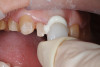 Fig 13. Starting at the central incisors, cementation is done all at one time, working posteriorly.