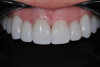 Fig 15. One week post-operative follow-up, with anterior zirconia used from Nos. 6 through 11 and posterior zirconia used on molars and bicuspids.