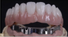 Fig 10. Removable denture-bar-supported Hader clip attachments.