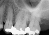 Fig 5. Preoperative No. 14 maxillary left first molar.