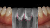Fig 9. Post-treatment radiographic analysis shows augmented pink and white.