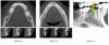 Fig 2. CBCT images and digital implant treatment planning for implant placement at edentulous site No. 19. (a) Initial CBCT presentation at edentulous site No. 19 demonstrating inadequate bone volume for implant placement. (b) CBCT image 5 months following a lateral ridge augmentation at No. 19 edentulous site with demonstrated increase in bone volume. (c) Digital implant placement at edentulous site No. 19 using a software-based three-dimensional reconstruction with CBCT data.