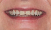 Fig 4. Initial orthodontic situation, showing patient’s relaxed smile with worn incisal edge display..