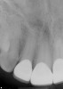 Fig 8. Final periapical radiographs of the restorations prior to delivery. The marginal integrity interproximally is evaluated to ensure adequate seating of restorations and closed margins.