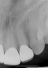 Fig 9. Final periapical radiographs of the restorations prior to delivery. The marginal integrity interproximally is evaluated to ensure adequate seating of restorations and closed margins.