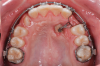 Fig 4. Swinging gate type of auxiliary used for direct traction of a palatal canine managed with open exposure.