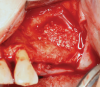 Fig 5. Bone replacement graft placement within prepared sinus site.