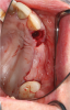 Fig 8. Incision design at maxillary left quadrant in preparation for lateral ridge augmentation.
