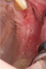 Fig 14. Two-week postoperative healing at maxillary left quadrant lateral ridge augmentation.