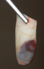 Fig 15. In a separate case, prepared L-PRF for use as a biologic bandage at palatal donor site after FGG harvest is shown (Fig 15); intraoperative photograph (Fig 16) shows L-PRF membrane sutured at palatal wound site after FGG harvest for postoperative pain control.