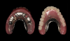 Fig 7. Processed overdenture prosthesis with housings/patricies incorporated into processing techniques.