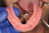 Fig 12. Prior to implant procedures, the prosthesis is tried in and adjusted until passively fitting onto edentulous ridge