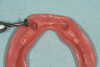 Fig 14. Recesses within complete denture are prepared using burs that are designed for overdenture procedures.