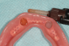Fig 16. Composite resin is applied into prepared recesses within the prosthesis and seated onto edentulous ridge, holding the prosthesis lightly ensuring complete adaptation to the edentulous ridge.