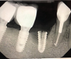 (3.) An implant with a conical connection demonstrating fracture of the thin walls at the coronal aspect (Radiograph courtesy of Ramsey Amin, DDS).
