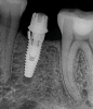 (4.) A failed implant that underwent mechanical overloading leading to fracture of the coronal portion adjacent to the implant-abutment connection.