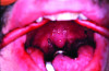 Fig 10.  The soft palate prior to UPPP surgery and after UPPP surgery. Note that a band of scar tissue replaces the uvula and tonsils (Figures courtesy of Dr. Brent Senior, School of Medicine, University of North Carolina at Chapel Hill).