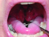 Fig 15. Clinical observations raising concern about the possibility of OSA. Note the large, thick tongue with scalloping on the lateral border with highly crowded oropharynx by enlarged “kissing tonsils.”
