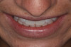 (5.) Tip-down smile photo. The maxillary incisal edge should land on, or point towards, the vermilion border (wet/dry line) of the lower lip.