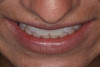 (5.) Tip-down smile photo. The maxillary incisal edge should land on, or point towards, the vermilion border (wet/dry line) of the lower lip.