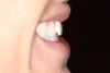 (6.) Profile smile photo. The maxillary incisal edge should land on, or point towards, the vermilion border (wet/dry line) of the lower lip.