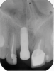 Fig 5. A 35-year-old patient with a missing central incisor due to trauma was restored with an implant (Fig 5, day of second-stage surgery). Twelve years later she presented to the office complaining that pus was draining from the implant and she felt uncomfortable. As can be seen in Fig 6, severe peri-implant bone loss due to peri-implantitis was evident.