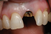 Fig 1. Badly damaged endodontically treated maxillary anterior tooth.