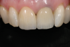 Fig 2. Final restoration at 2 years resulting in gray “show-through” and a compromised esthetic result.