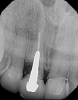 Fig 3. In a separate case, radiograph of a decayed endodontically treated tooth is shown. The decision was made to extract it before further damage to adjacent teeth and/or loss of bone could occur.