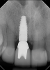 Fig 4. Radiograph of the implant to replace the tooth in Fig 3 (implant placed by David Levine, DDS).
