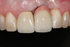Fig 8. In a separate example, this is a case where the use of gingival-colored porcelain resulted in poor esthetics and accessibility for proper hygiene. A decision to extract should have been made sooner.