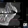 (8.) An original finding of a small lesion on the mesial root of tooth No. 30 was not accompanied by any outward symptoms; therefore, the patient delayed pursuing treatment. When a follow-up CBCT scan was acquired 6 years later, the easy-to-visualize increase in the dimensions of the lesion motivated the patient to elect a treatment plan.