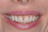 Fig 9. Initial presentation of patient with defective maxillary central incisor veneers.