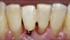 Fig 13. Extracted tooth modified and bonded as a provisional pontic.