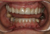 Fig 13. Definitive restorations Nos. 3 through 12 (implant No. 9) and Nos. 23 through 26 seated.