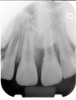 Fig 4. Preoperative radiograph showing aggressive external root resorption and thin dentinal walls.