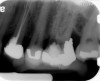 Fig 9 Preoperative radiographs showing mesial perforation.