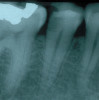Fig 3. Determining a diagnosis with a radiograph only can lead the clinician to treat tooth No. 29 because of the distal decay. However, if the proper diagnostic tests are performed on tooth No. 29, it should reveal the pulp tested necrotic and it is tooth No. 30 that has a symptomatic irreversible pulpitis.