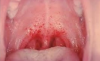 Fig 2. Enathem of the soft palate in a patient with COVID-19. (Image courtesy of Steven Reitan, DDS, with AZPerio.)